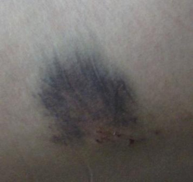 16-bruise-and-scars-from-the-descent